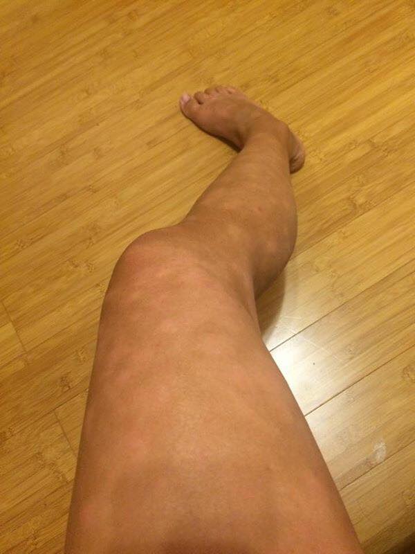 Leg (eczema worsened) 1