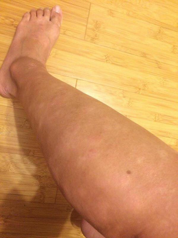 Other leg (eczema worsened) 2